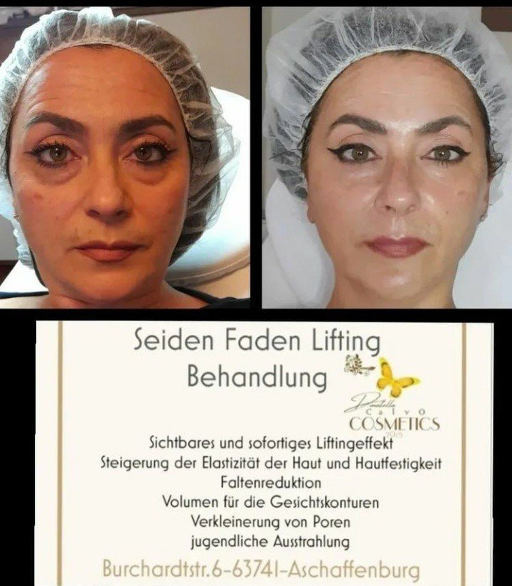 Seidenfaden Faden Lifting Behandlung für Kosmetik Institute Set 8 Produkte – Bild 2